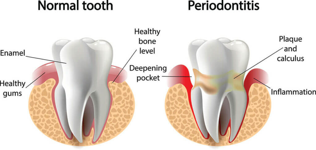 Chart Showing a Normal Tooth Compared to One With Periodontitis