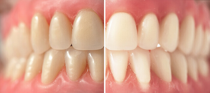 Close Up of Teeth Before and After Whitening